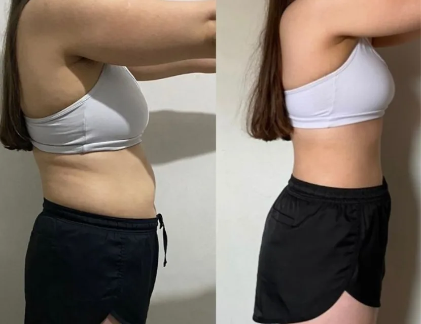 Antes e depois — Reduz o inchaço e a retenção